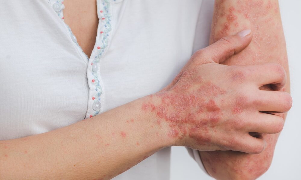 Na fotografiji je osoba koja drži svoju ruku. Ruka i dio podlaktice su prekriveni psorijazom. Osoba nosi bijelu majicu s cvjetnim detaljima uz vratni izrez. Psorijaza se čini koncentriranim na ruci i podlaktici, prikazujući crvene mrlje i upaljenu kožu. Pozadina je jednostavna i bijela, što usmjerava pažnju na zahvaćeno područje kože.