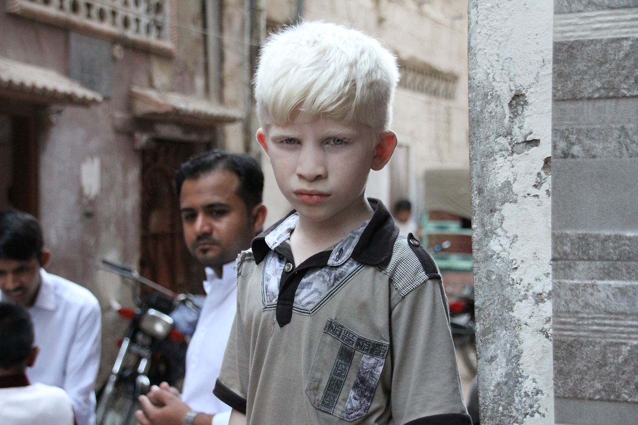 Na fotografiji je prikazana tema vezana uz albinizam. Albinizam je genetski uvjet koji rezultira nedostatkom pigmenta u koži, kosi i očima.