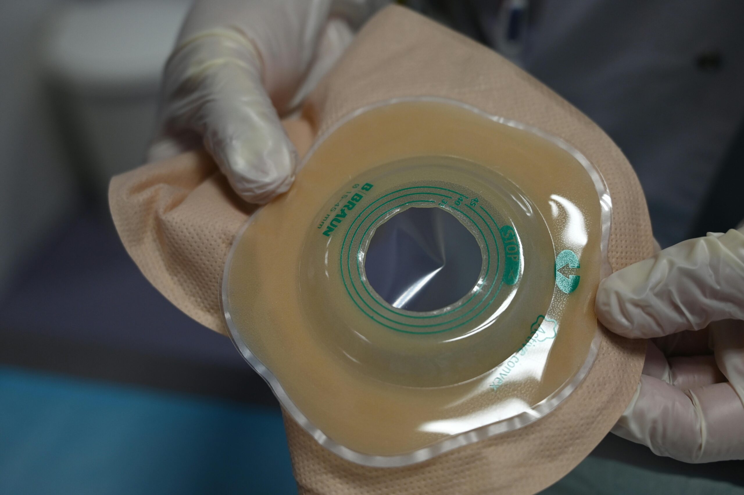 Na slici se vide ruke u medicinskim rukavicama koje drže stomijsku vrećicu ili medicinski stomijski uređaj. Uređaj je bež boje, izrađen od mekanog materijala, s prozirnim kružnim otvorom u sredini. Na njemu se nalaze zeleni natpisi i oznake. Pozadina je zamućena, što sugerira bolničko ili kliničko okruženje.